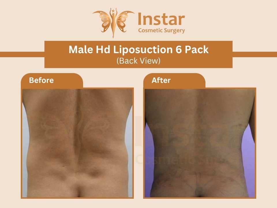 Male-Hd-Liposuction6-Pack -Back-View